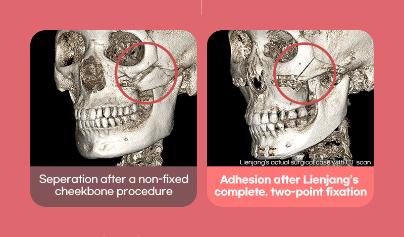 Complete fixation explanation with image showing with and without adhesion