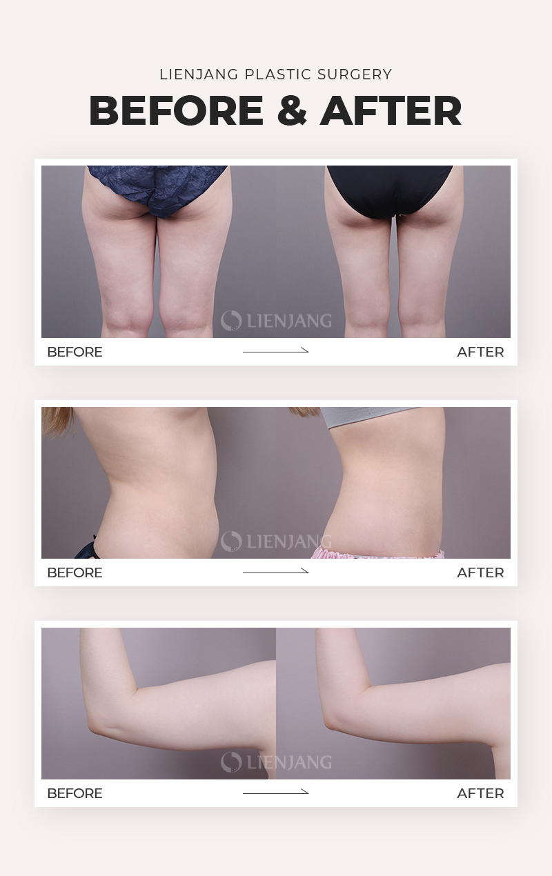 Before and after photos after liposuction