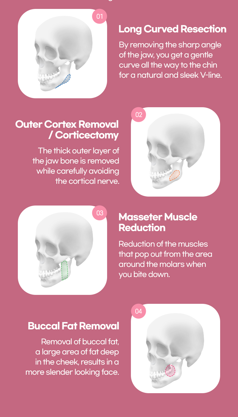 The different procedure performed with Square Jaw reduction