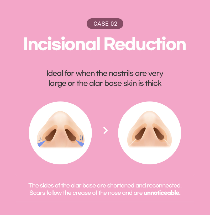 Incisional method for Lienjang Alar reduction, nostril reduction, or Alarplasty in Korea